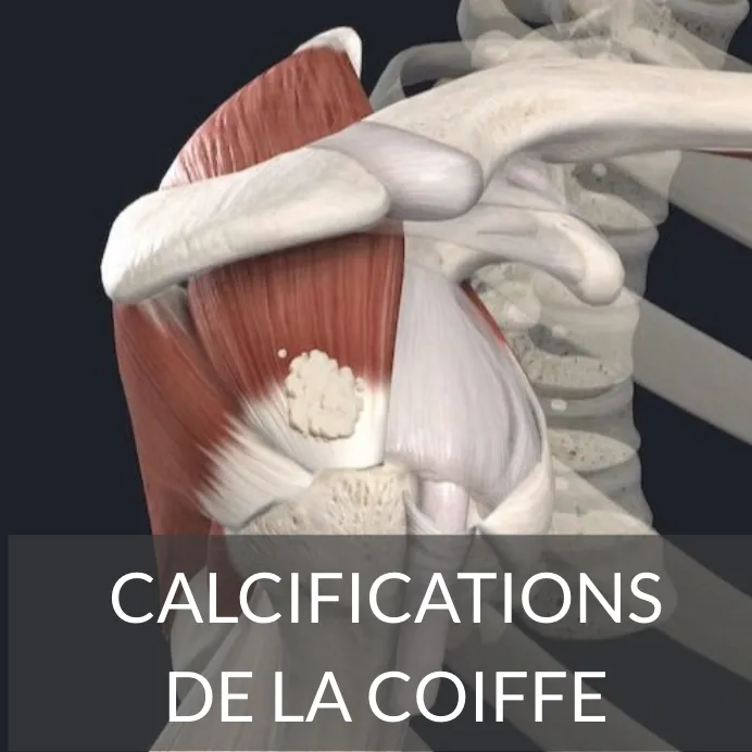 calcification de l'épaule