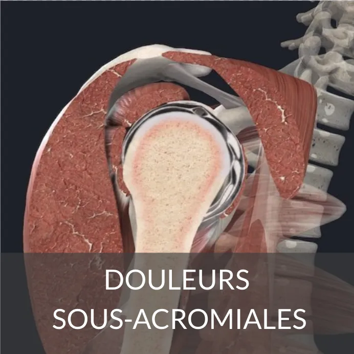 conflit sous acromial