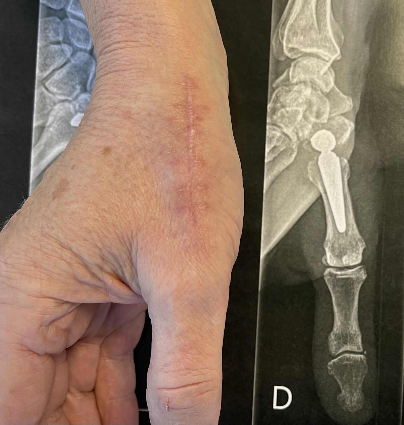 prothèse trapézo-métacarpienne