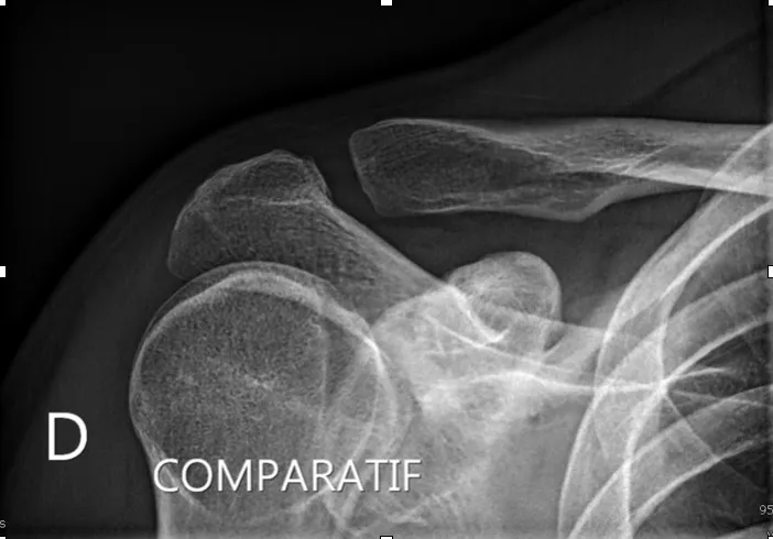 radiographie articulation acromio-claviculaire