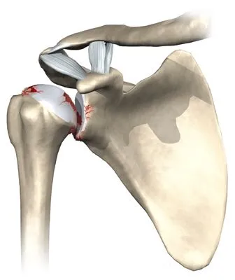 arthrose épaule
