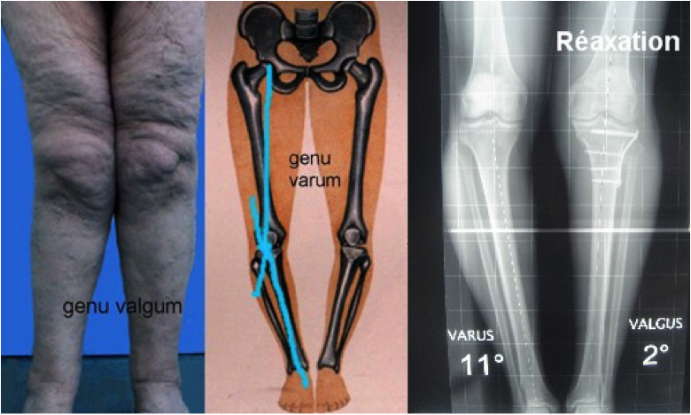 genu varum