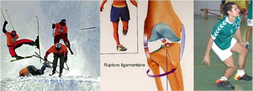 entorse grave du genou