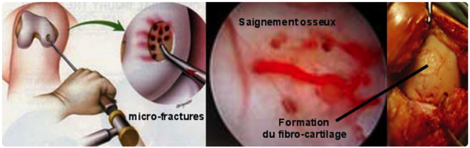 greffe de cartilage
