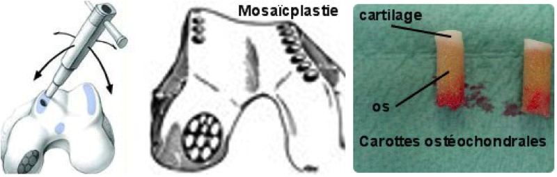 mosaicplastie