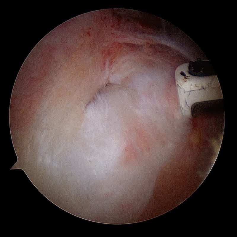 lésion du suprapinatus