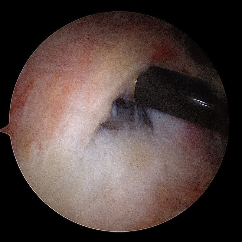 lésion dégénérative de la coiffe des rotateurs