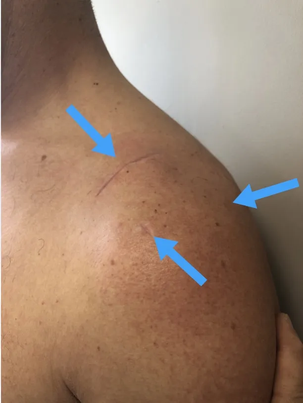 cicatrice acromio-claviculaire