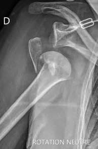 fracture luxation de l'épaule
