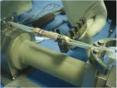 prétension ligamentaire