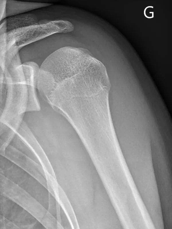 épaule après réduction de la luxation