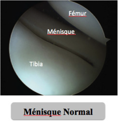 ménique normal