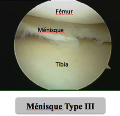 lésion méniscale