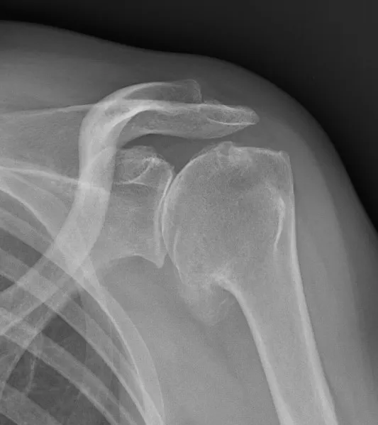 omarthrose primitive