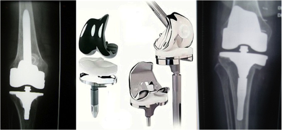 prtohèse totale du genou