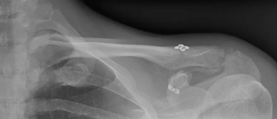 endobutton acromio-claviculaire