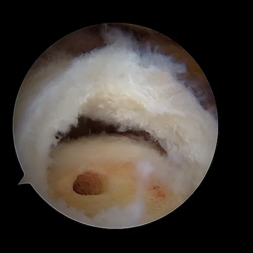 orifice ancre trochiter