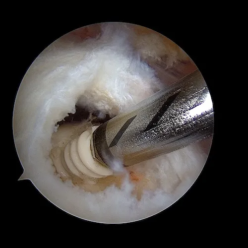 vissage ancre coiffe des rotateurs