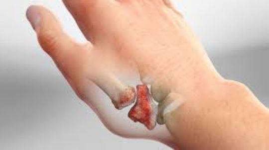 rhizarthrose