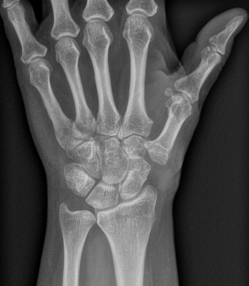 trapézectomie radiographie